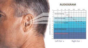 Mature,Man,With,Symptom,Of,Hearing,Loss,And,Audiogram,On